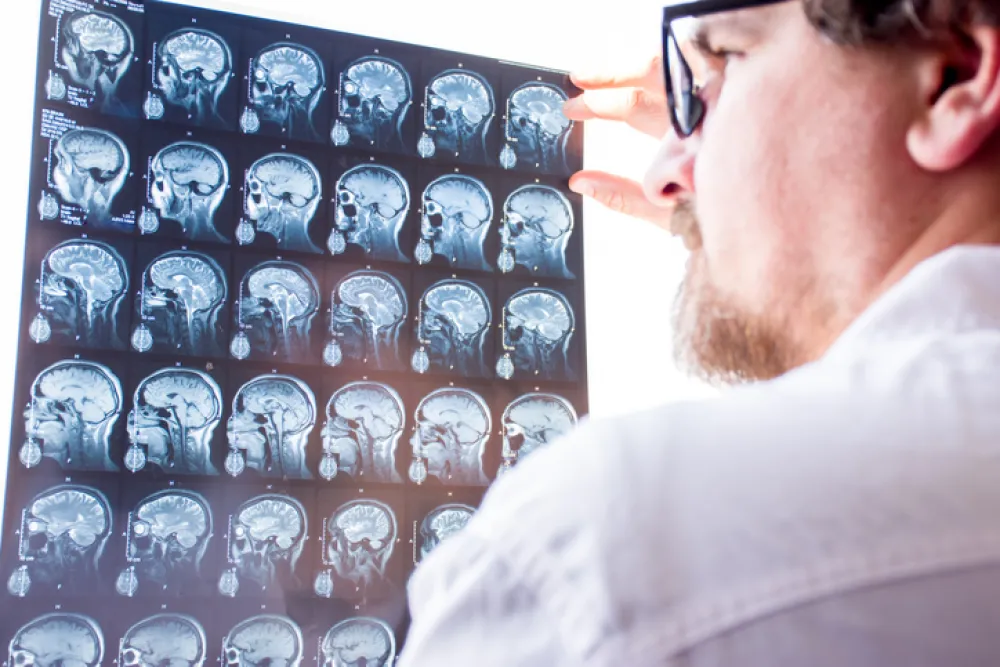 Foto de un medico observando una resonancia del cerebro de una persona