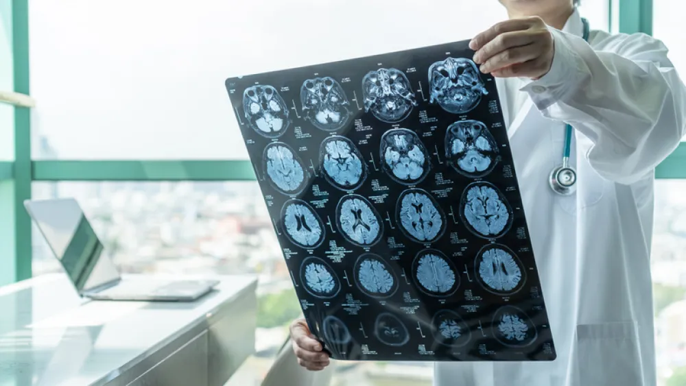 Foto de un médico observando unas radiografías de un cerebro